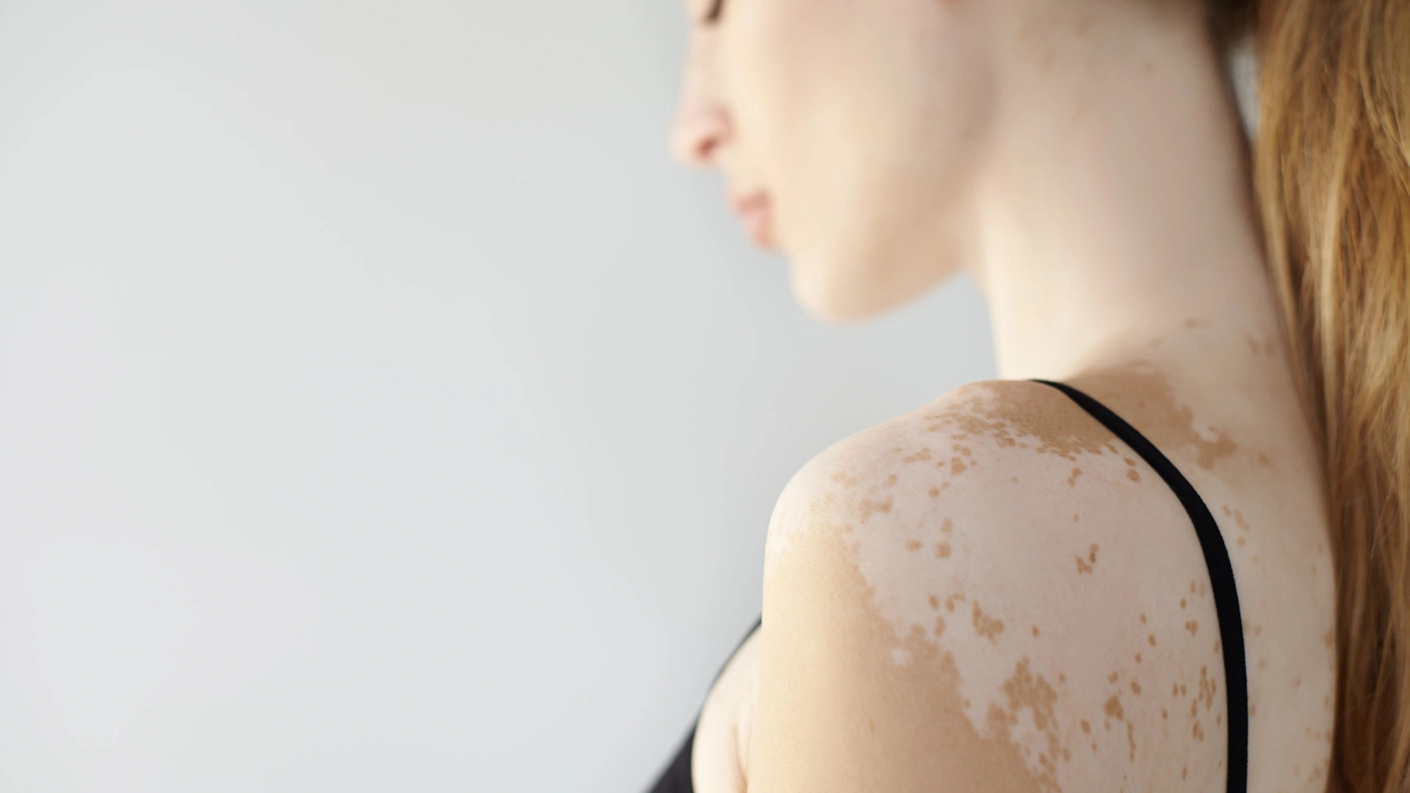 Is Vitiligo Hereditary Understanding the Inheritance of Skin Pigmentation Disorders