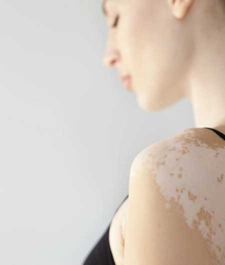 Is Vitiligo Hereditary Understanding the Inheritance of Skin Pigmentation Disorders