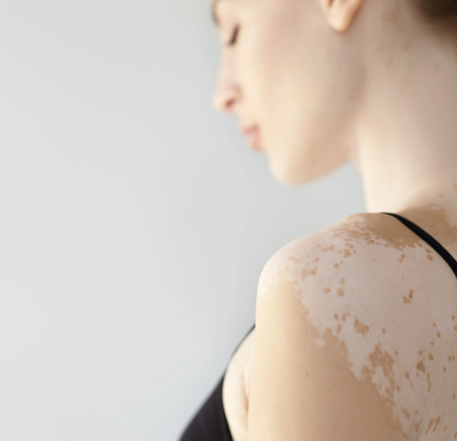 Is Vitiligo Hereditary Understanding the Inheritance of Skin Pigmentation Disorders